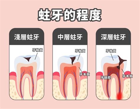 門牙痛|牙齒痛到睡不著？試試這五大牙痛緩解方法！